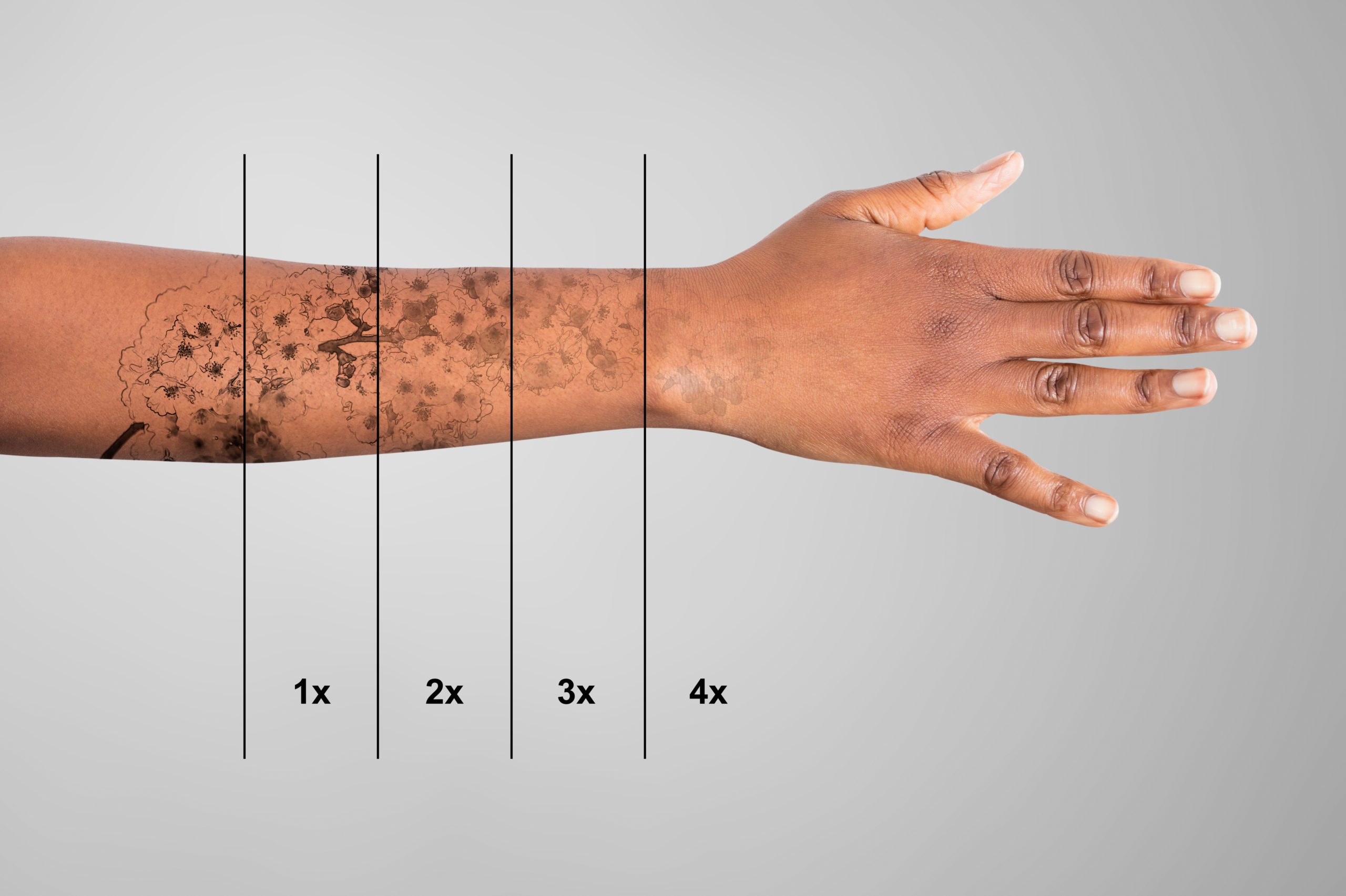 rimuovere tatuaggio: braccio